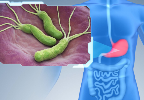 Vi khuẩn HP – Mối nguy tiềm ẩn gây ung thư dạ dày